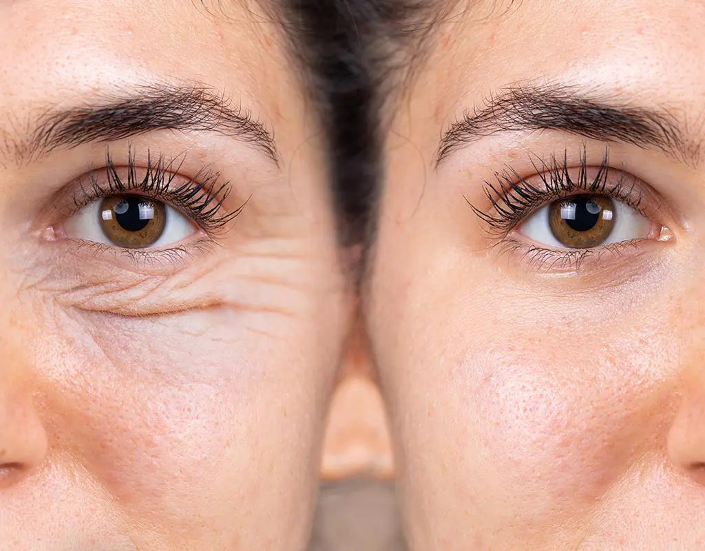 tratamientos-blefaroplastia